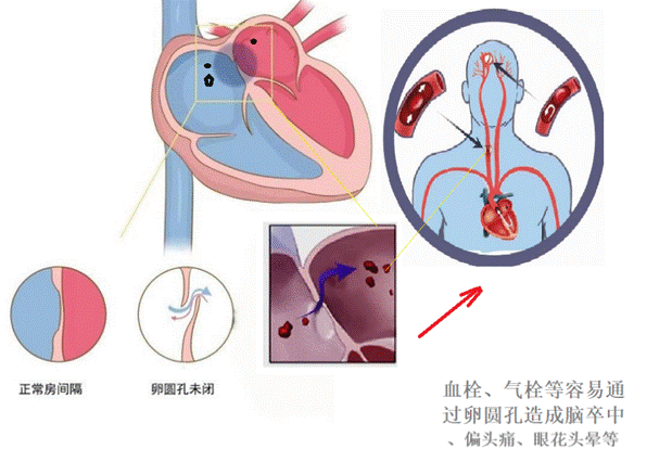 PFO及相关疾病引发机制